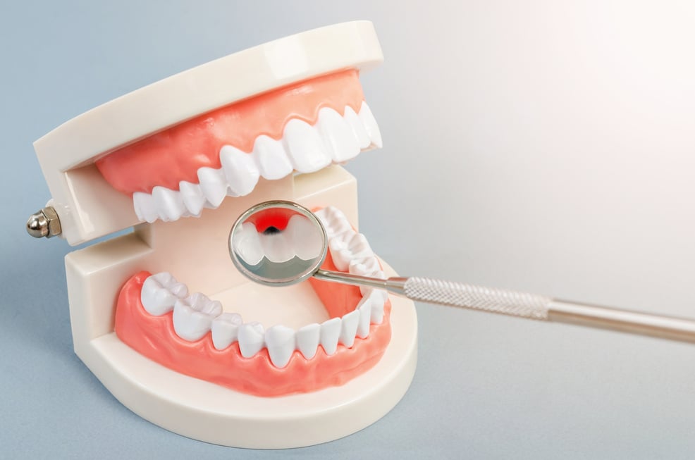 Tooth dental caries on denture with equipment dental.